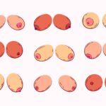 Inverted Nipple Correction